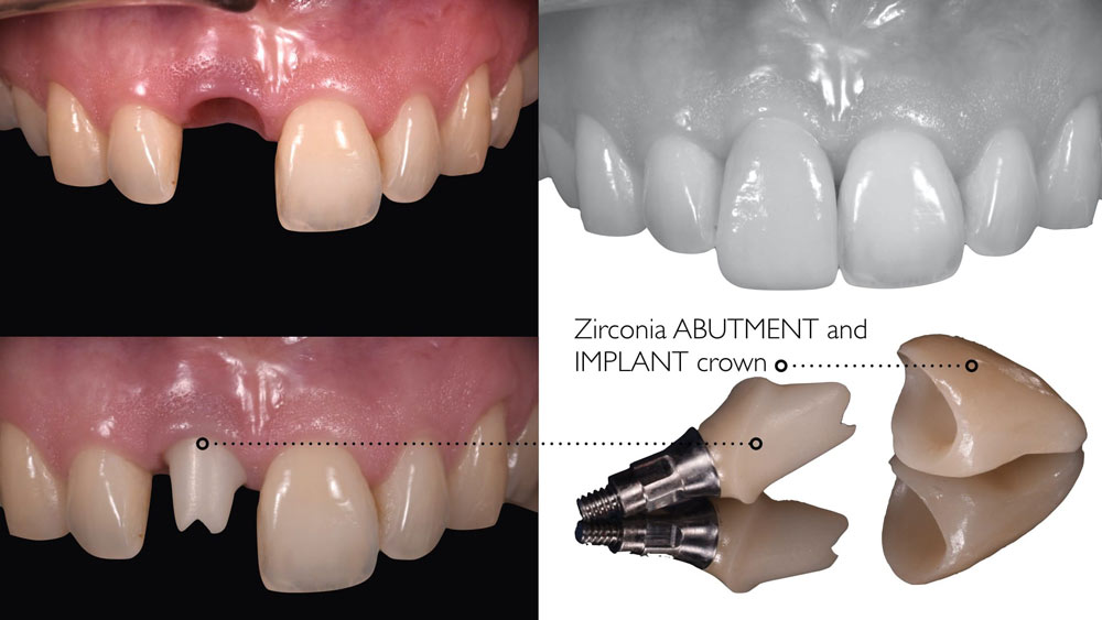 Before and after photos with zirconia abutment and implant crown