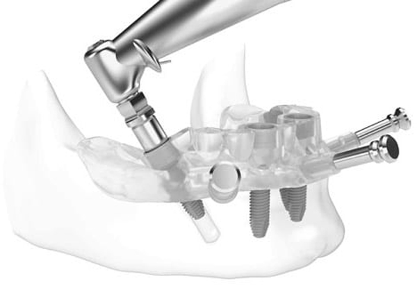 Rendering of jaw with implants put in place with guided implant surgery