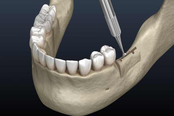 Cleavage of the alveolar ridge, augmentation. Dental surgery, 3D illustrationat Glen Perio in Glenview, IL Cleavage of the alveolar ridge, augmentation. Dental surgery, 3D illustrationat Glen Perio in Glenview, IL