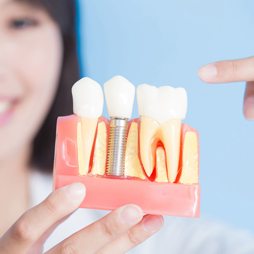 Doctor pointing to model of dental implant in model of teeth and gums.