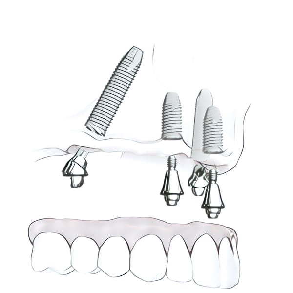 Rendering of multiple dental implants at Glen Perio in Glenview, IL