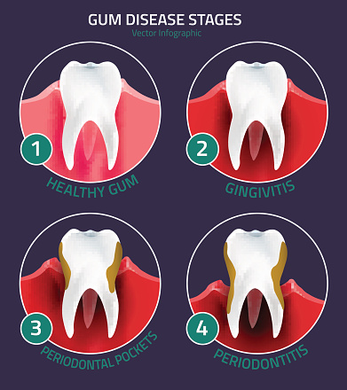 Image of a gingivitis stages, at Glen Perio.