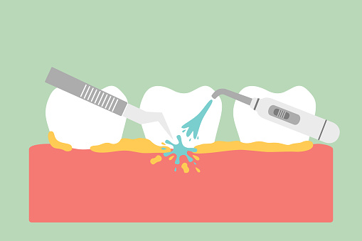 A 3d rendering of plaque and removal tools