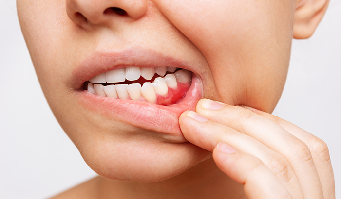 Woman with bleeding gums before making an appointment at Glen Perio in Glenview, IL