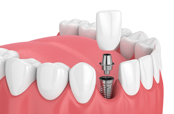 Rendering of jaw with dental implant. Rendering of jaw with dental implant.