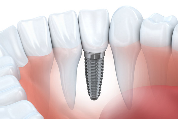 DDiagram of dental implant in lower jaw