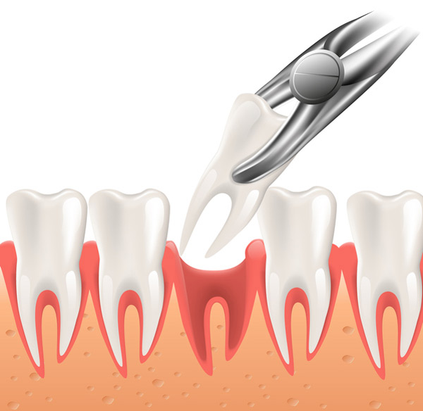 Diagram of a tooth being extracted