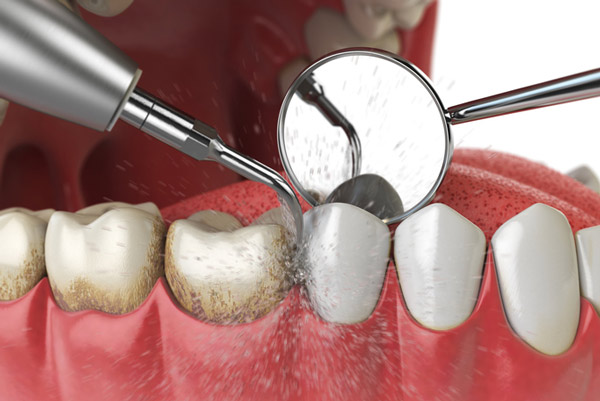 Rendering of periodontal maintenance treatment on teeth and gums