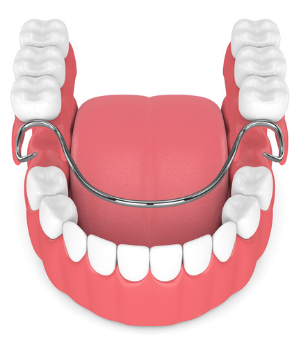 Image of an overdenture, at Glen Perio.