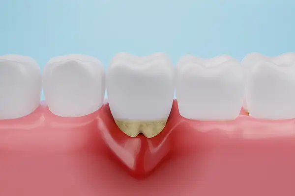 Close-up of a tooth with tartar buildup at the gum line, demonstrating the effects of untreated periodontal issues.