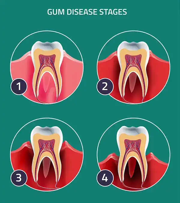 Infographic showing the four stages of gum disease and their symptoms, from healthy gums to advanced periodontitis with severe bone loss.