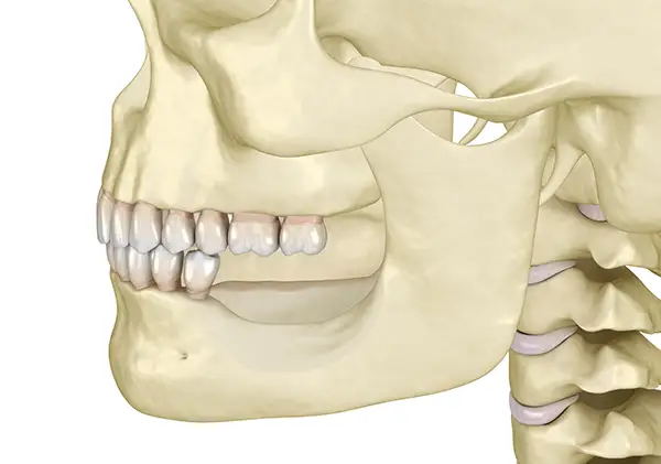 Skull with restored jawbone structure after a ridge restoration procedure that fixes bone recession after losing molar teeth.