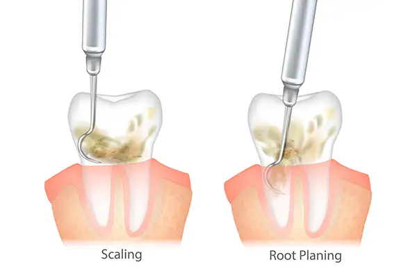 Diagram comparing dental scaling and root planing, showing how each procedure targets tartar removal.